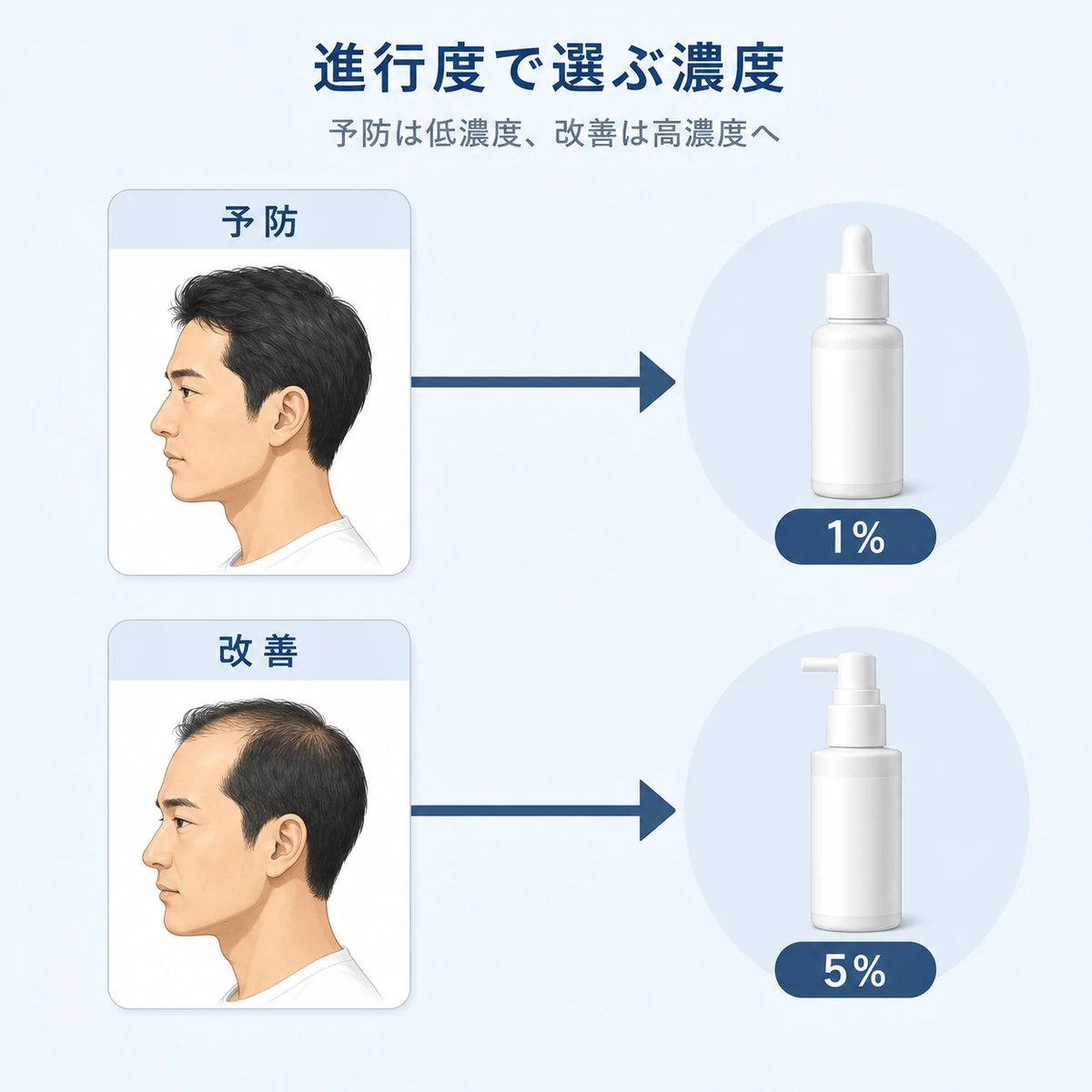薄毛の進行度に応じて1%と5%を選ぶ流れを矢印で表した男性向け医療イラスト