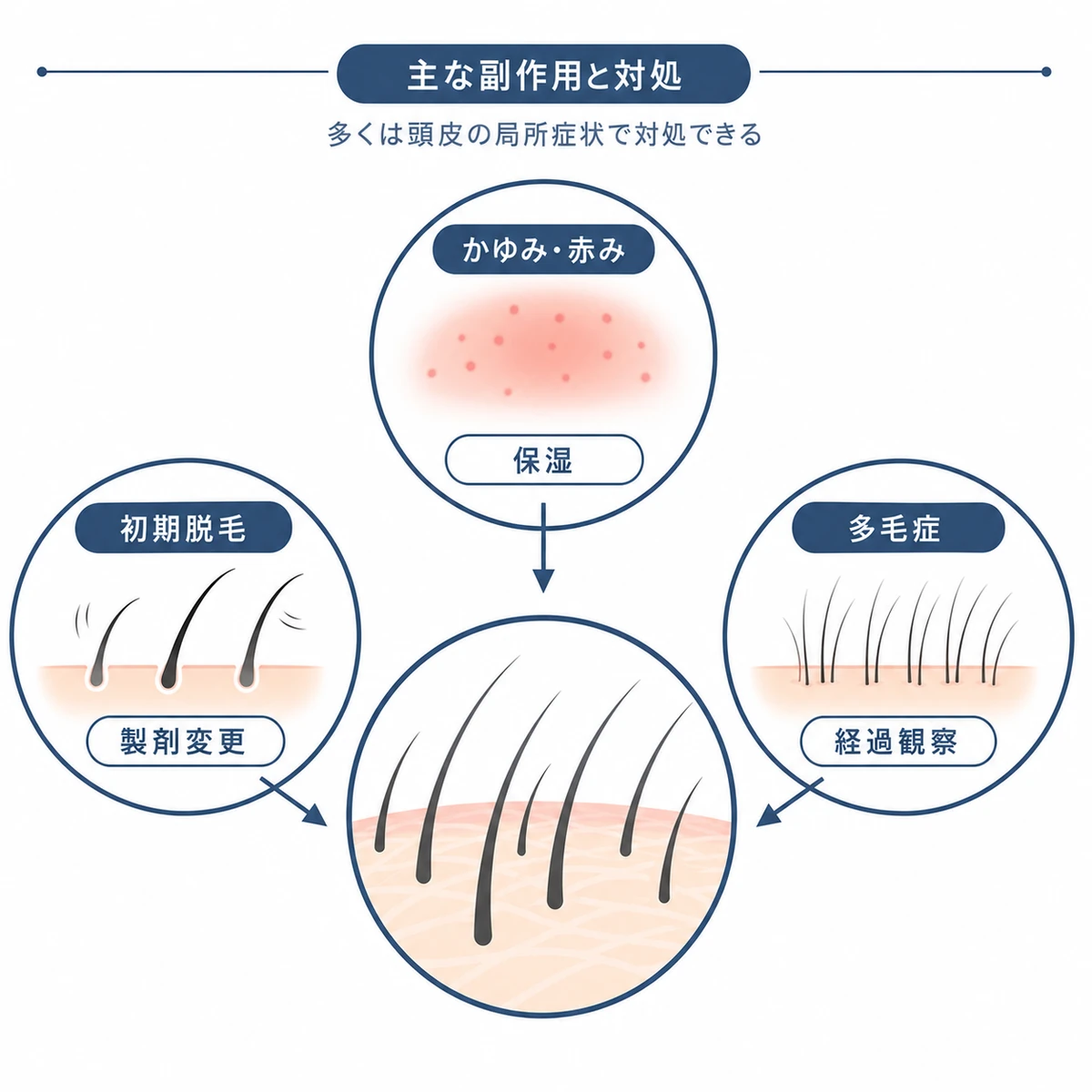 ミノキシジル外用で起こる主な副作用の種類と対処の方向を頭皮を中心にした相関図で表した医療イラスト