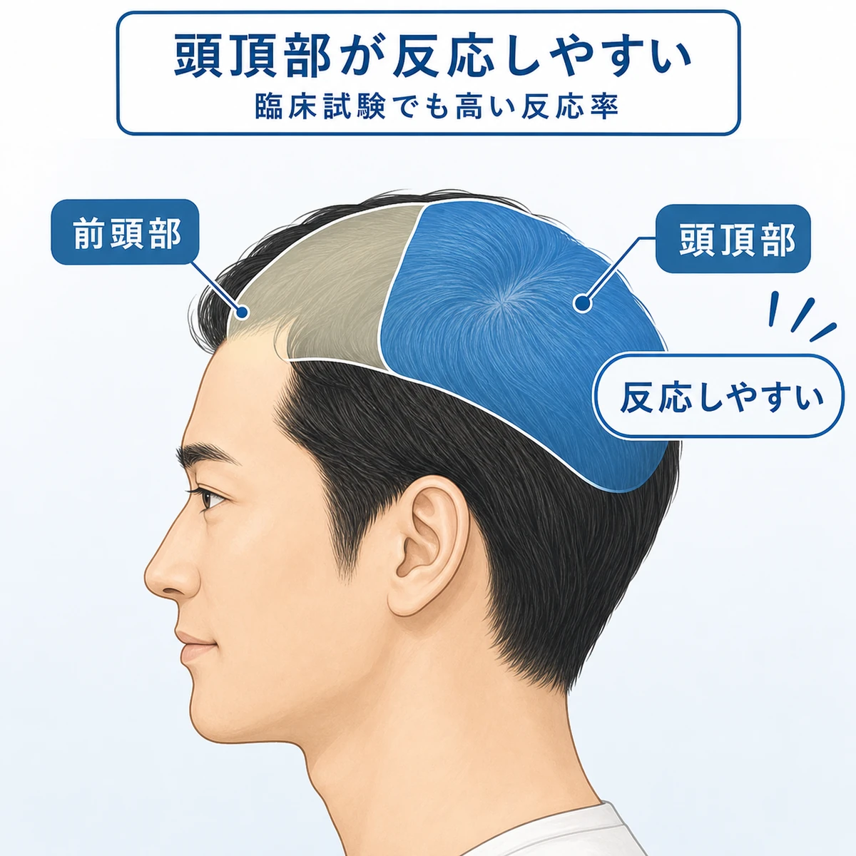 前頭部と頭頂部でミノキシジルの反応しやすさを比べた医療イラスト