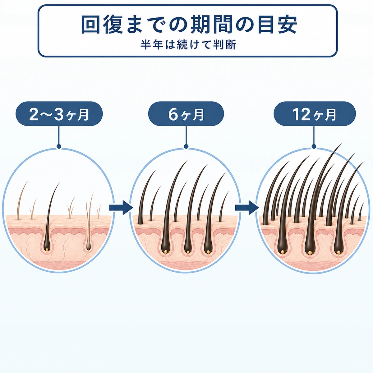 ミノキシジル使用開始から一年までの頭頂部の回復経過を表した医療イラスト