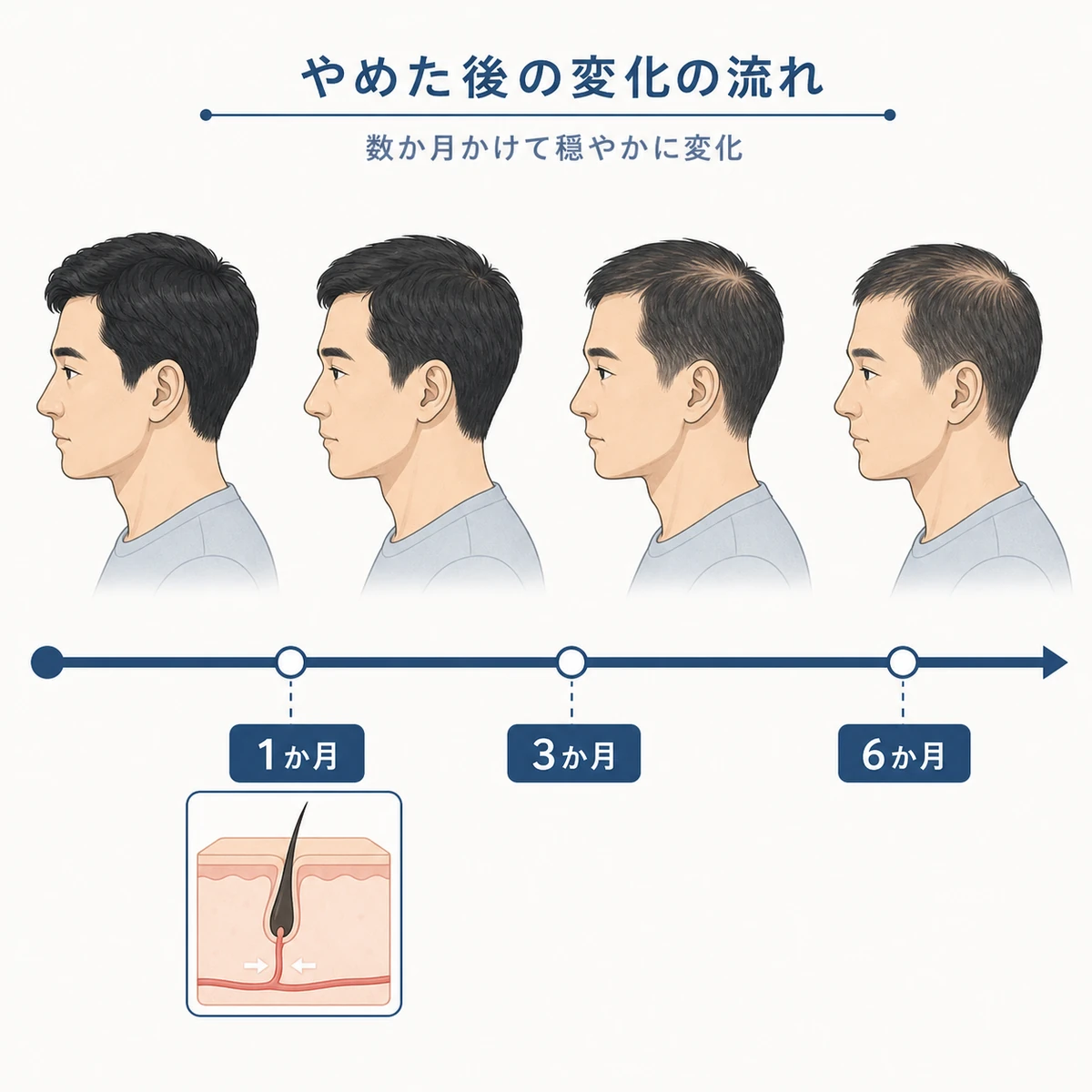 ミノキシジル中止後に髪の状態が数か月かけて変化していく経過を左から右へ示した医療イラスト
