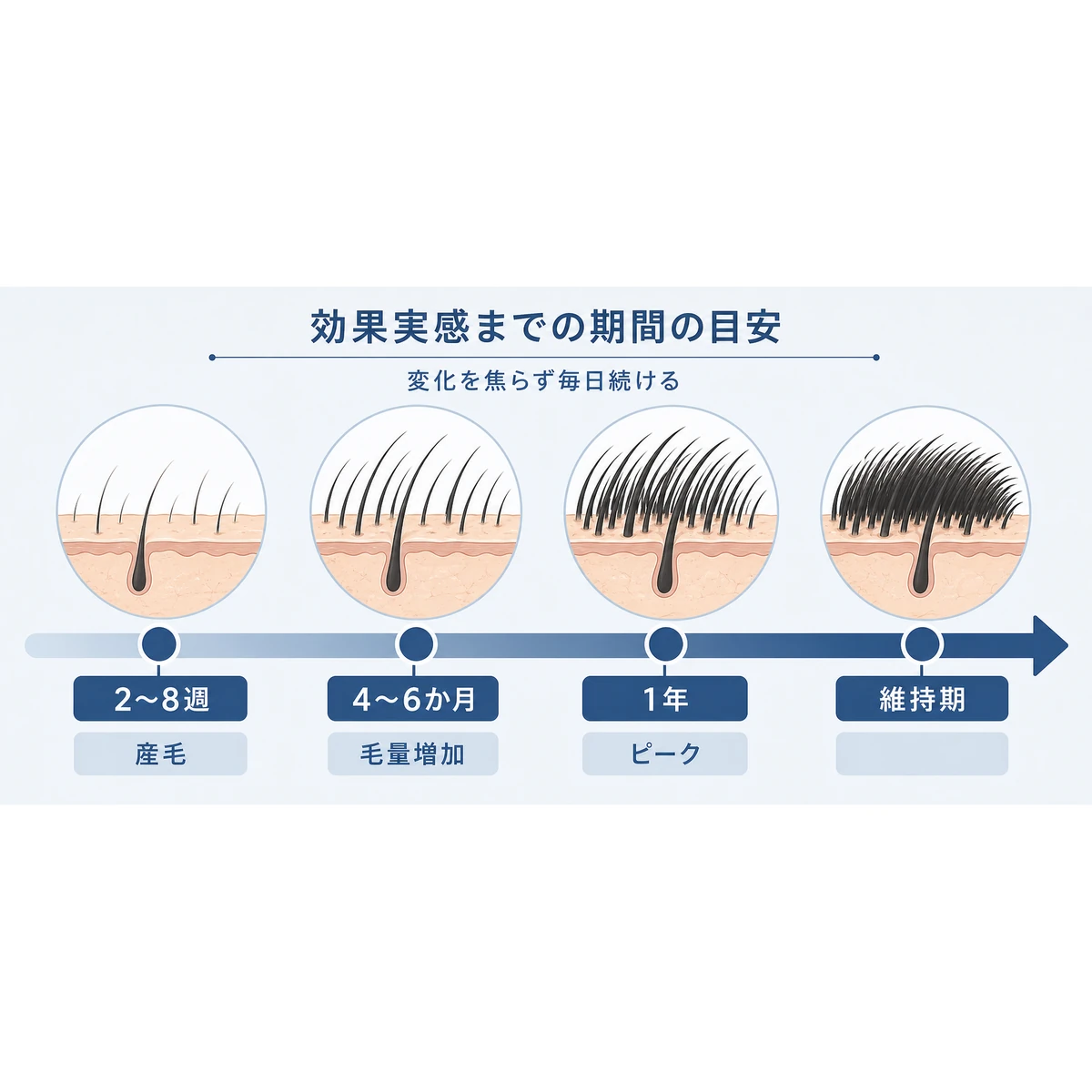 ミノキシジルの効果実感までの期間の目安を段階で示した医療イラスト