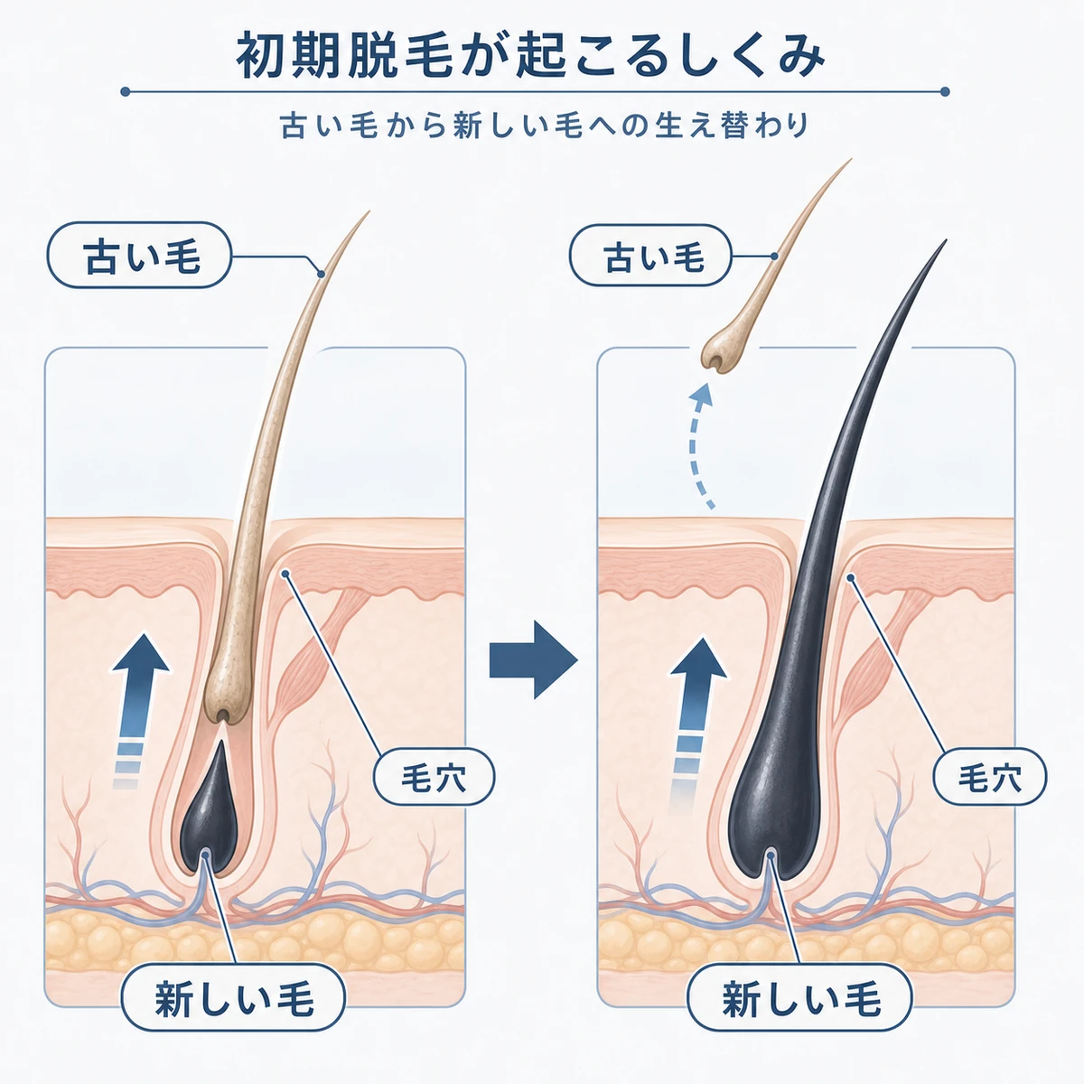 初期脱毛で古い毛が新しい毛に押し出される生え替わりのしくみを表した医療イラスト