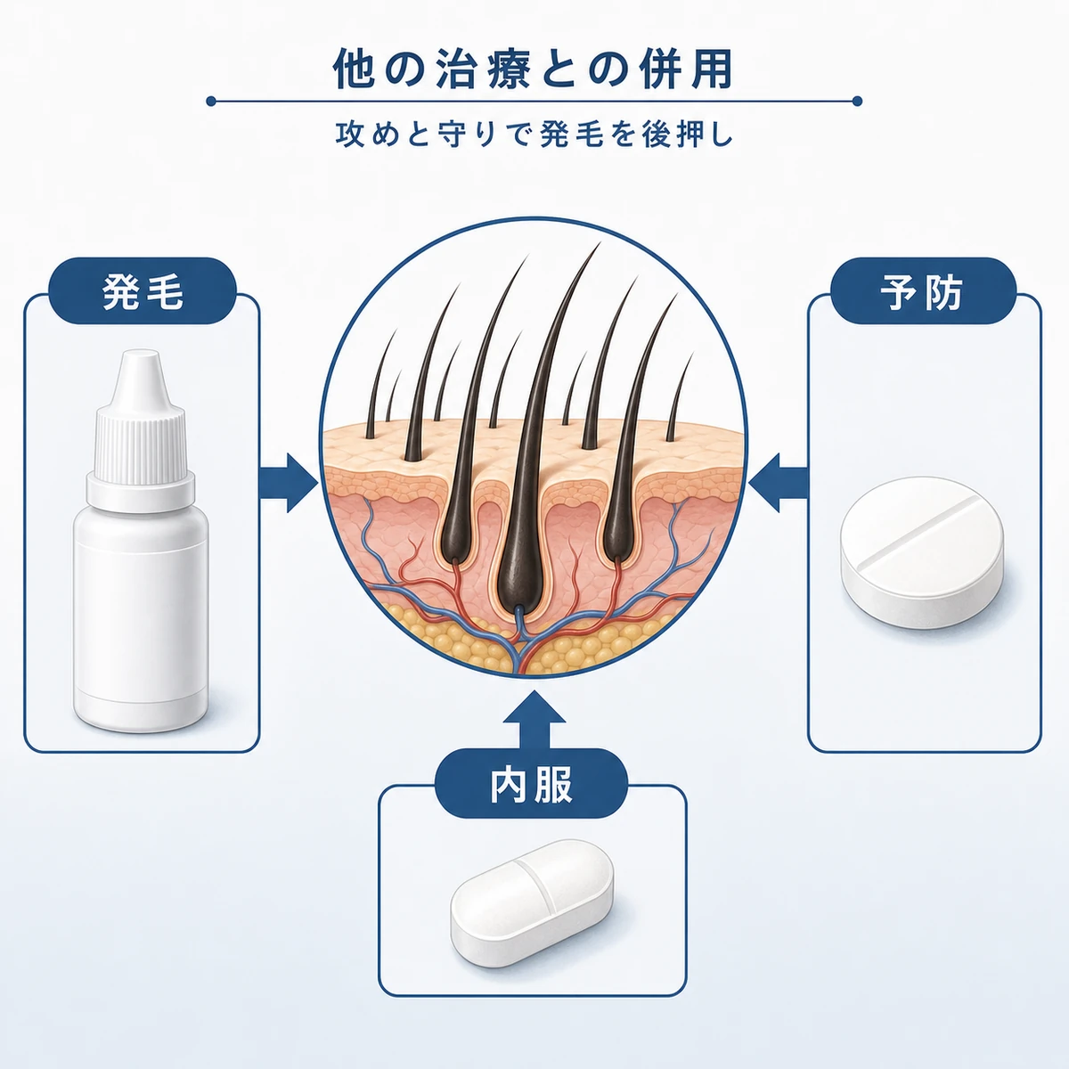ミノキシジルと他の治療を併用して発毛を後押しする組み合わせを表した医療イラスト