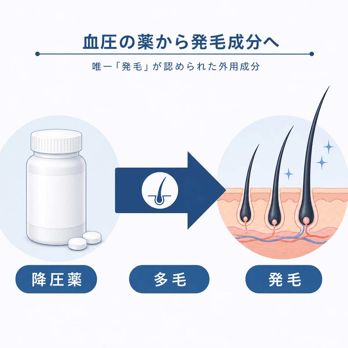 ミノキシジルが降圧薬から発毛成分へと変わった経緯を表した医療イラスト