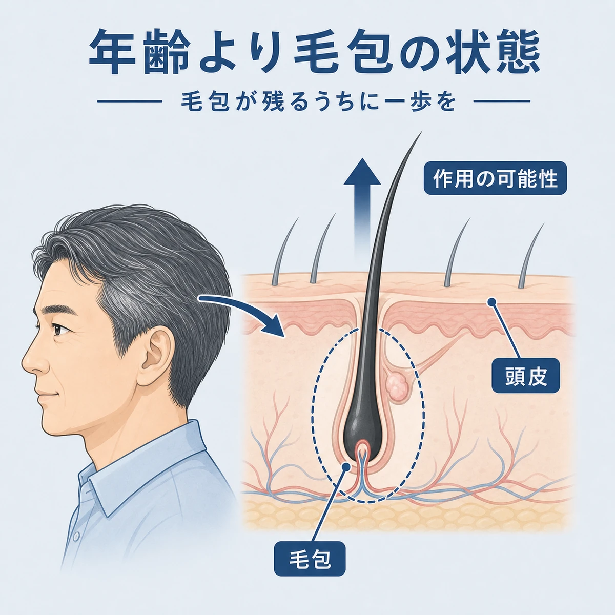 頭皮に残る毛包にミノキシジルが働きかける可能性を表した医療イラスト