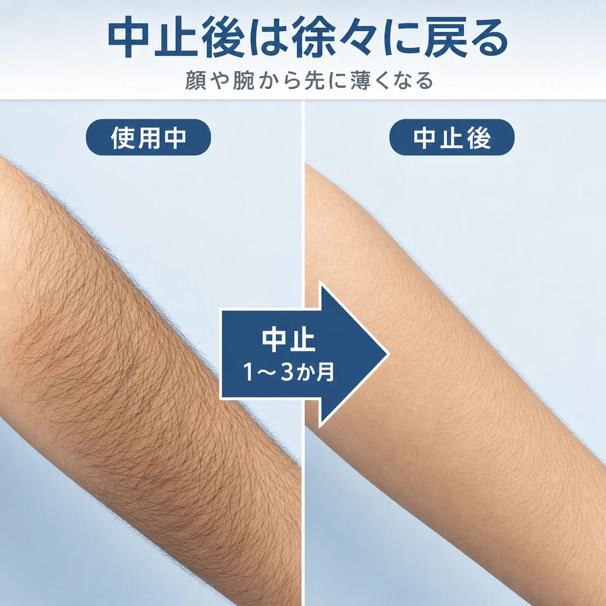 ミノキシジル中止後に腕の体毛が時間とともに元に戻る変化を左右で表した医療イラスト