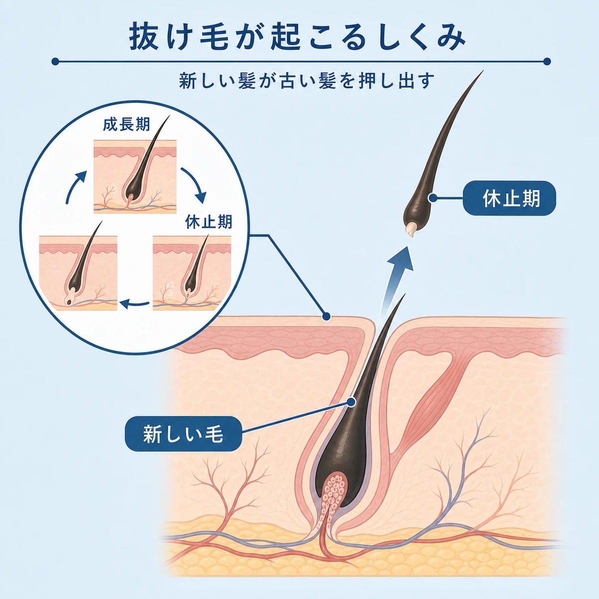 ミノキシジルで新しい髪が古い髪を押し出す毛根のしくみを表した医療イラスト