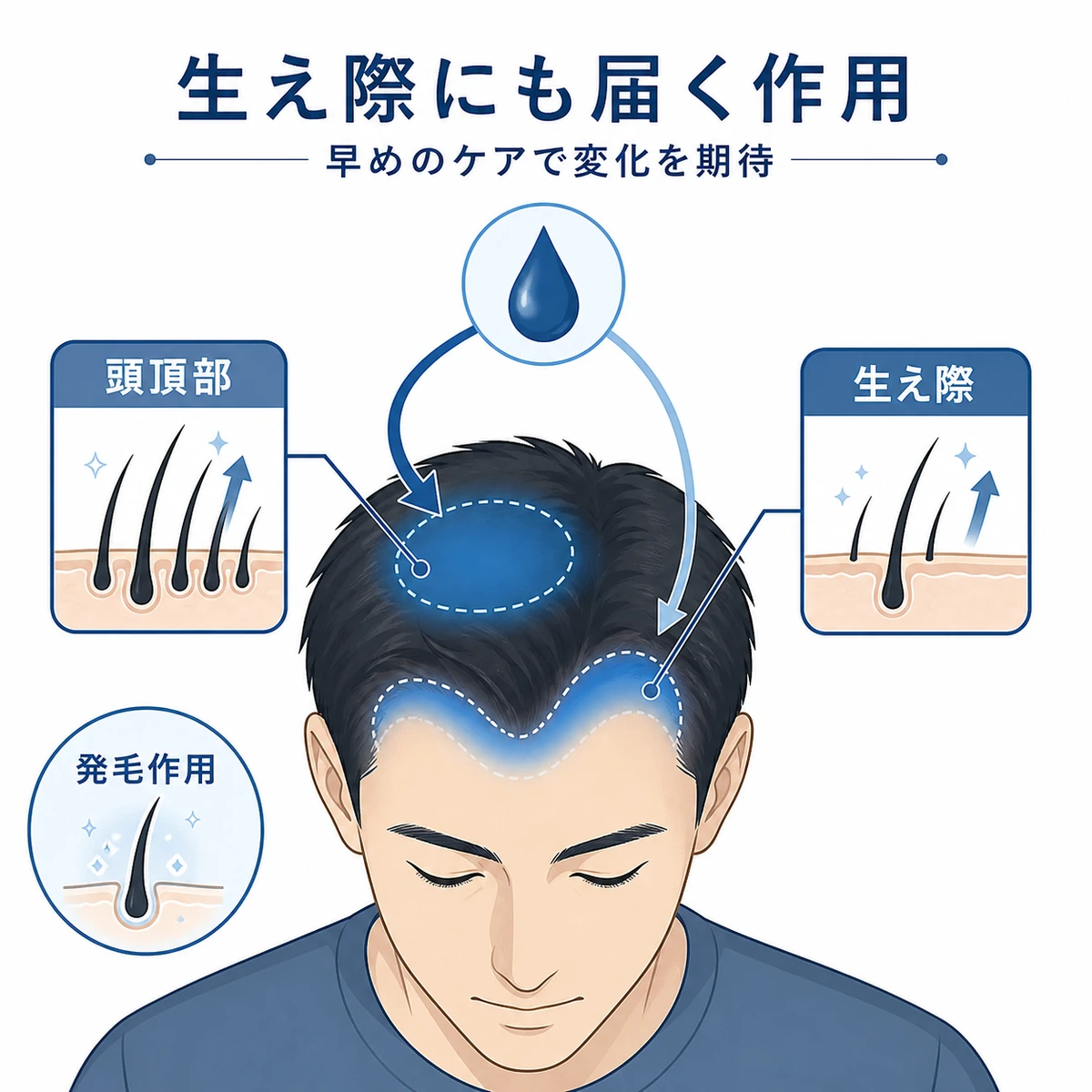 ミノキシジルが頭頂部と生え際の両方の毛包に作用するしくみを表した医療イラスト