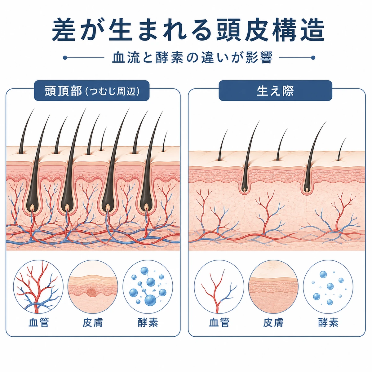 頭頂部と生え際の頭皮構造の違いを比べた断面図の医療イラスト