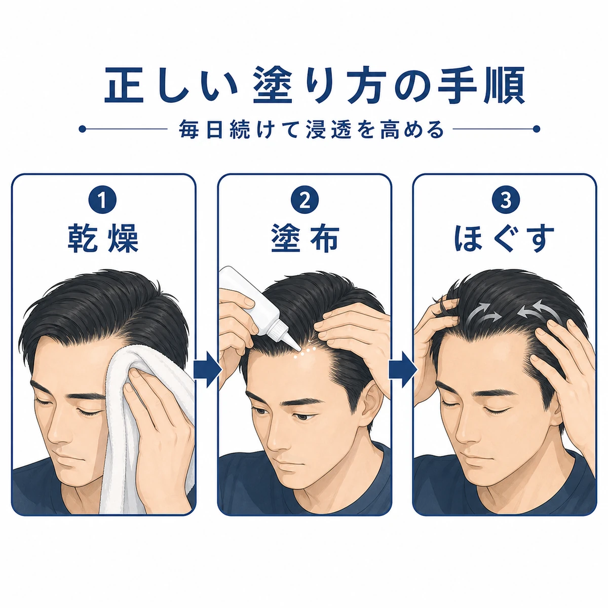 生え際へのミノキシジルの正しい塗布手順を段階的に示した医療イラスト