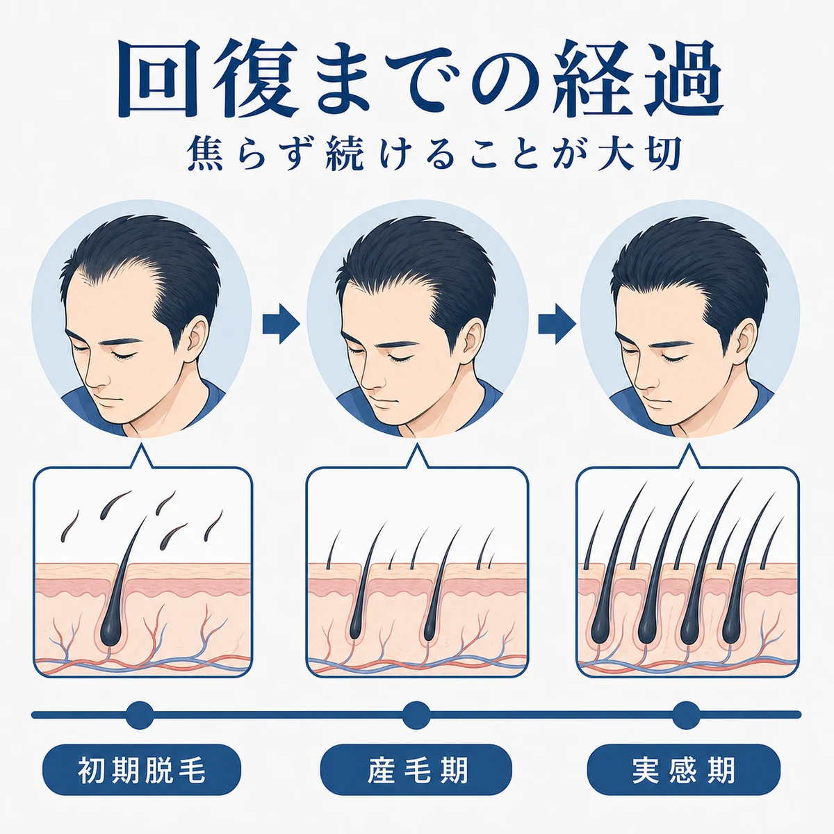 ミノキシジル使用開始から生え際が回復するまでの経過を段階で表した医療イラスト