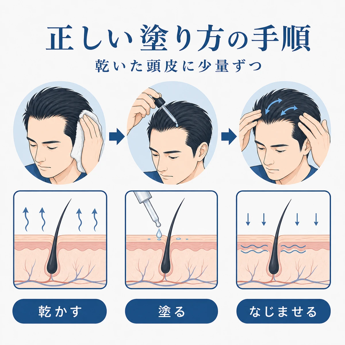 生え際にミノキシジルを塗る正しい手順を描いた成人男性の医療イラスト
