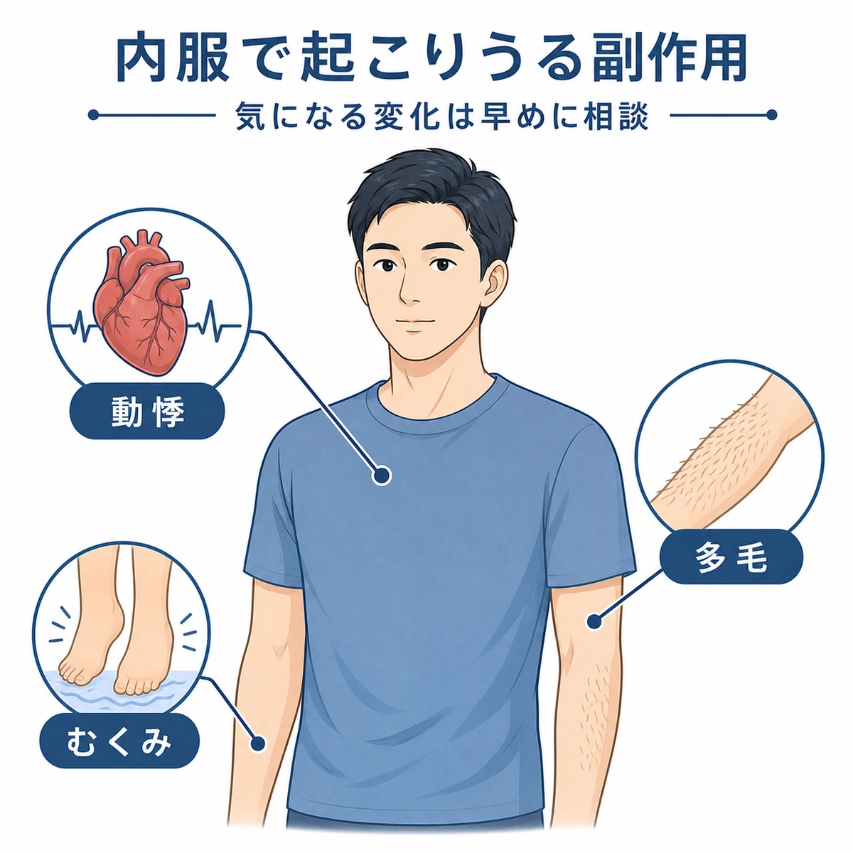 内服薬で起こりうる動悸・むくみ・多毛の副作用を成人男性の図で表した医療イラスト