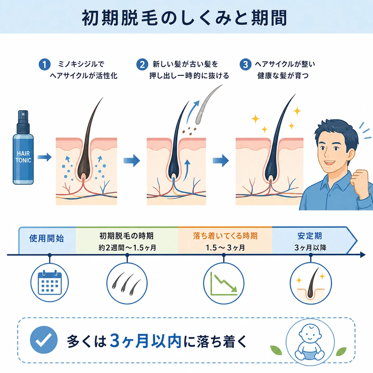 初期脱毛で新しい髪が古い髪を押し出し数ヶ月で落ち着くまでの流れを表した医療イラスト