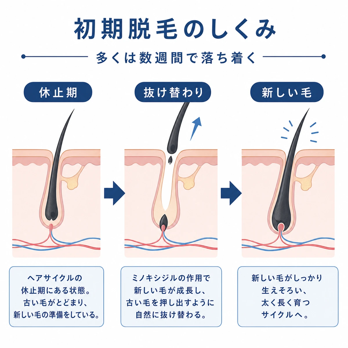 休止期から新しい毛へと生え替わる初期脱毛の流れを表した医療イラスト