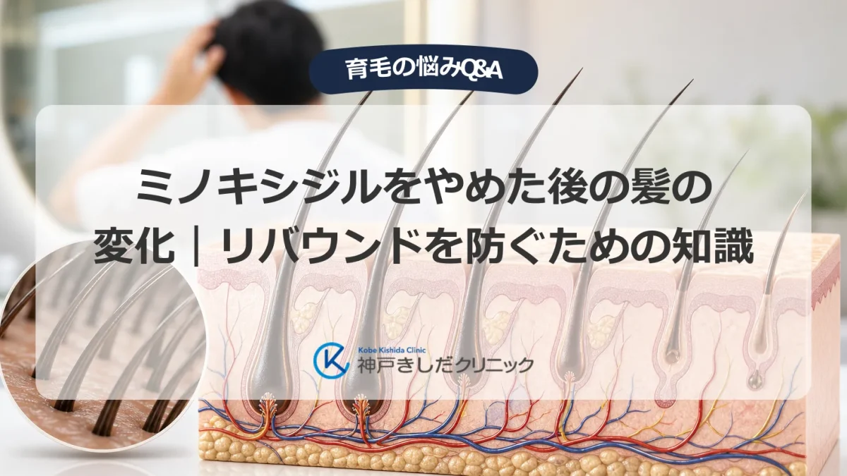 ミノキシジルの中止後に起きる髪と頭皮の変化をあらわす医療イメージ