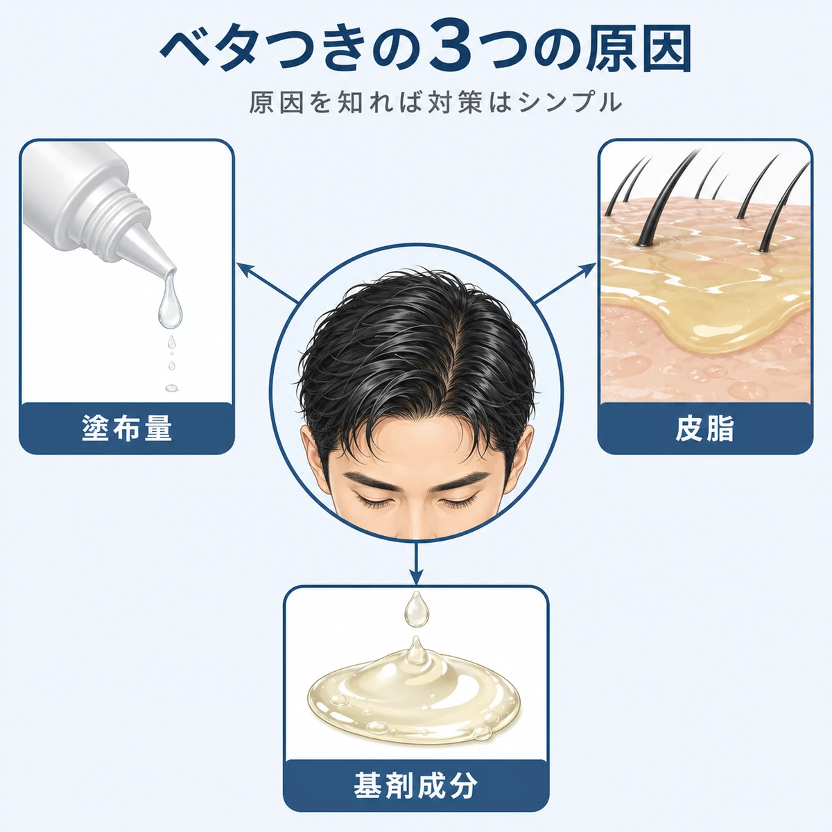 朝の育毛剤がベタつく3つの原因を頭皮を中心に結んだ相関図の医療イラスト