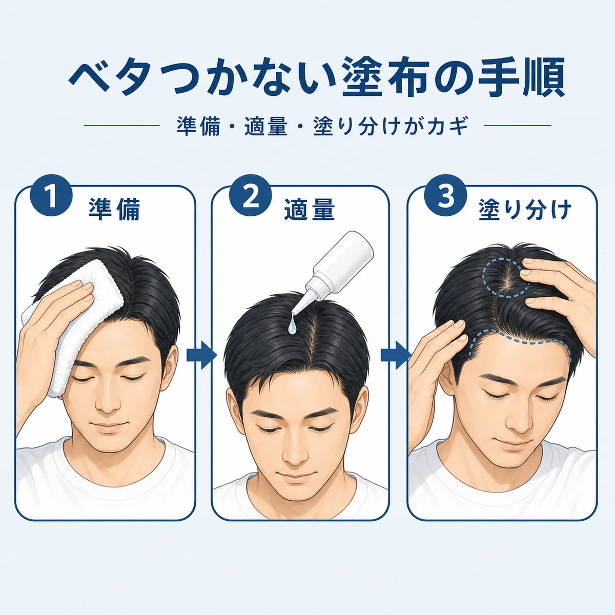 頭皮の準備から適量塗布・塗り分けまでを左から右へ示した育毛剤の塗布手順の医療イラスト