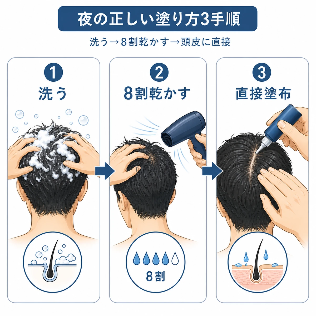 頭皮を洗い8割乾かしてから育毛剤を直接塗る夜の正しい手順を左から右に並べた医療イラスト