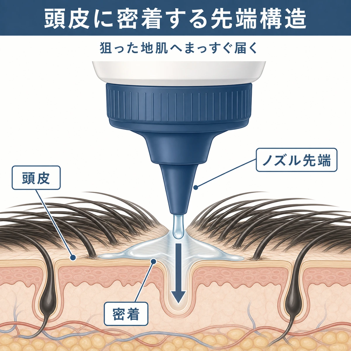 ノズル型育毛剤の先端が頭皮に密着して液が下向きに届く構造を表した断面イラスト
