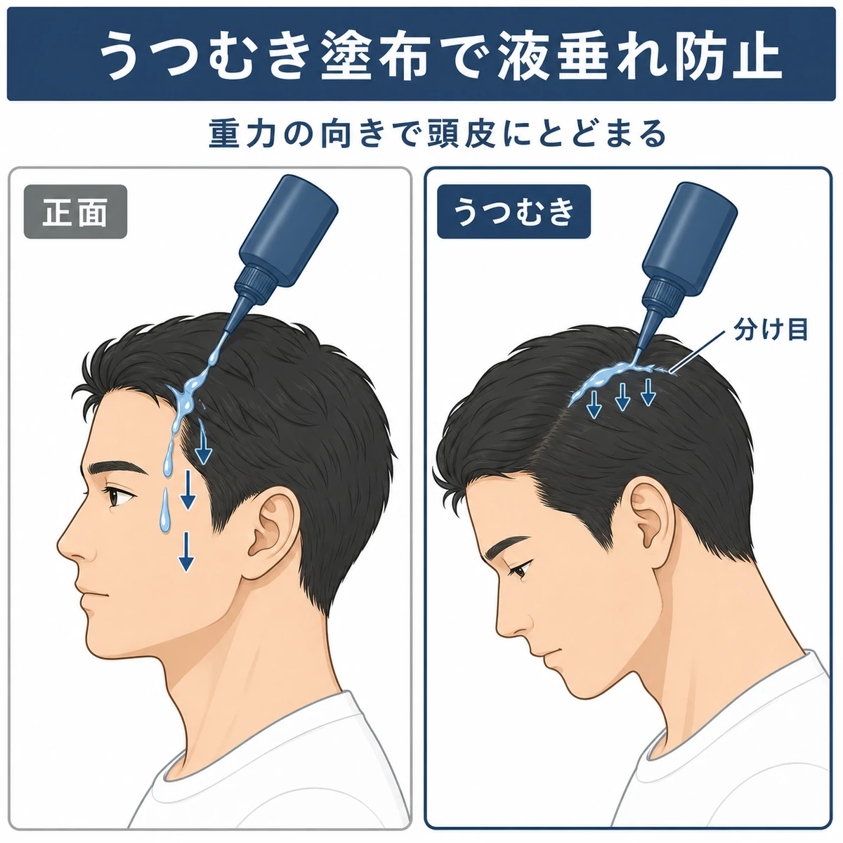 正面向きとうつむき姿勢を比べてノズル型育毛剤の液垂れを防ぐ塗り方を表したイラスト