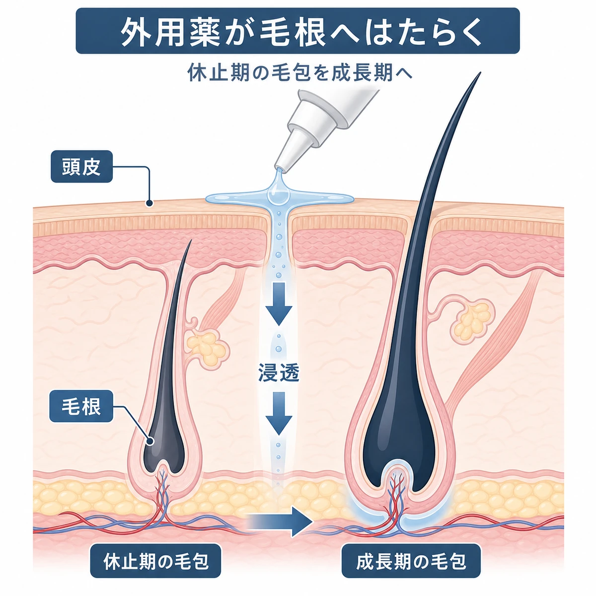 外用育毛剤が頭皮の毛穴から毛根へ下向きに浸透してはたらく仕組みを表した頭皮断面の育毛イラスト