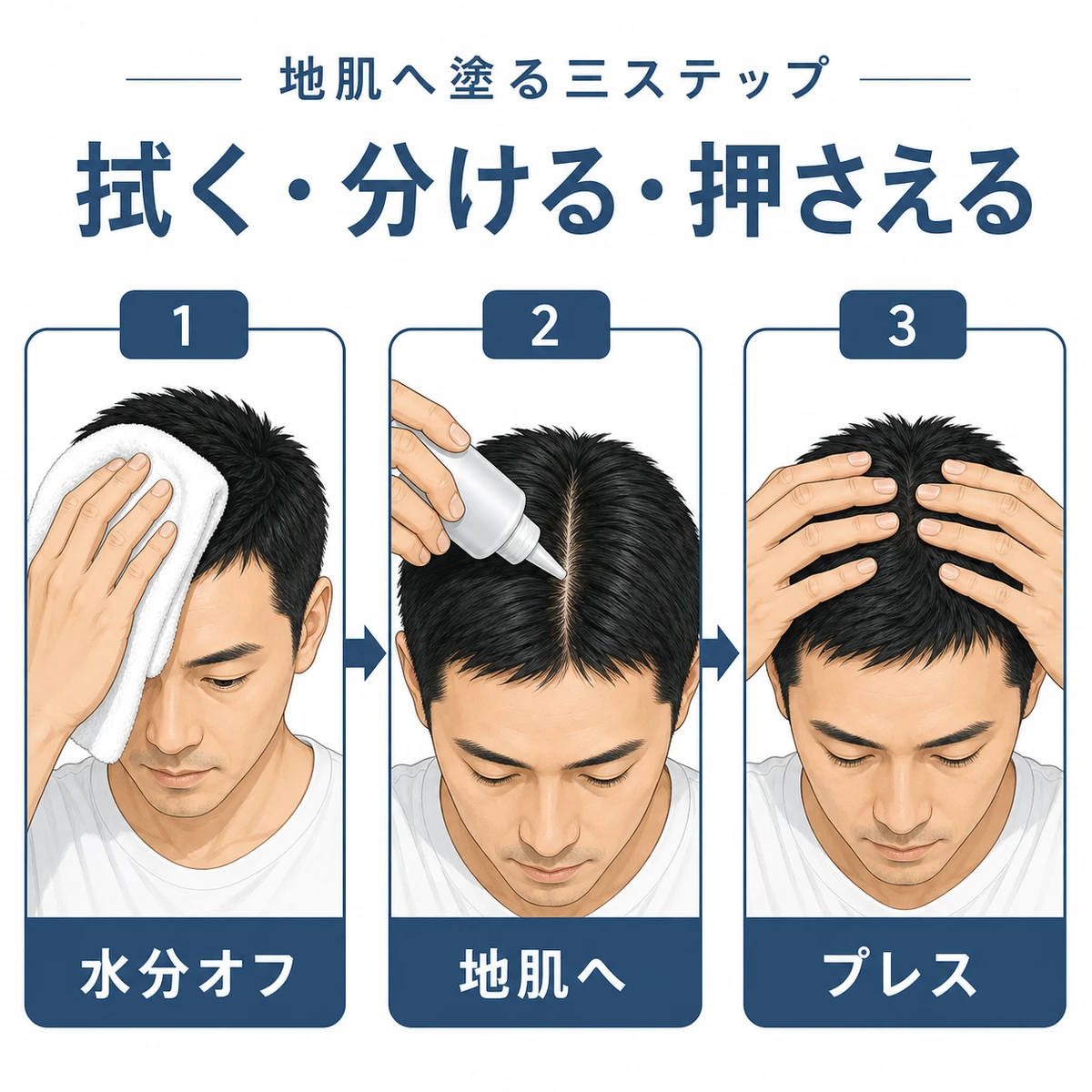 育毛剤を地肌へ塗る三つの手順の流れを示した医療イラスト