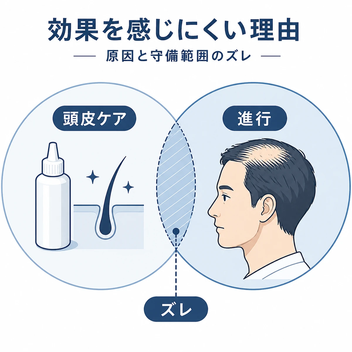 市販の育毛剤の守備範囲と進行した薄毛のズレを表した医療イラスト