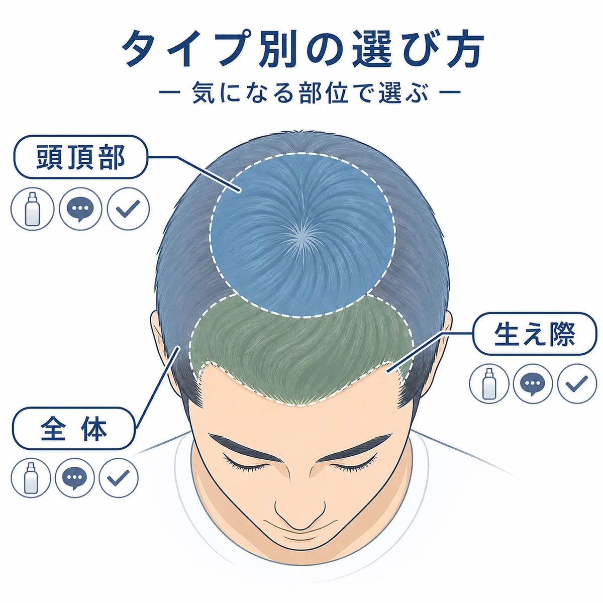 薄毛のタイプ別に育毛剤を選ぶポイントを頭部マップで表した医療イラスト