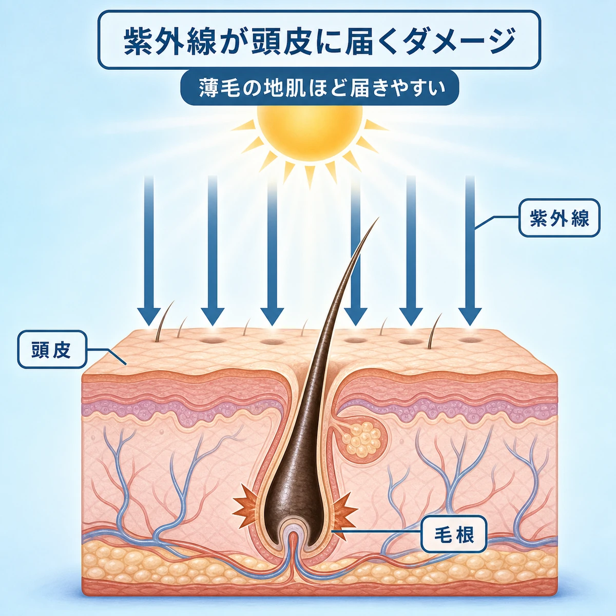 紫外線が頭皮に降り注ぎ毛根にダメージを与えるしくみを表した医療イラスト