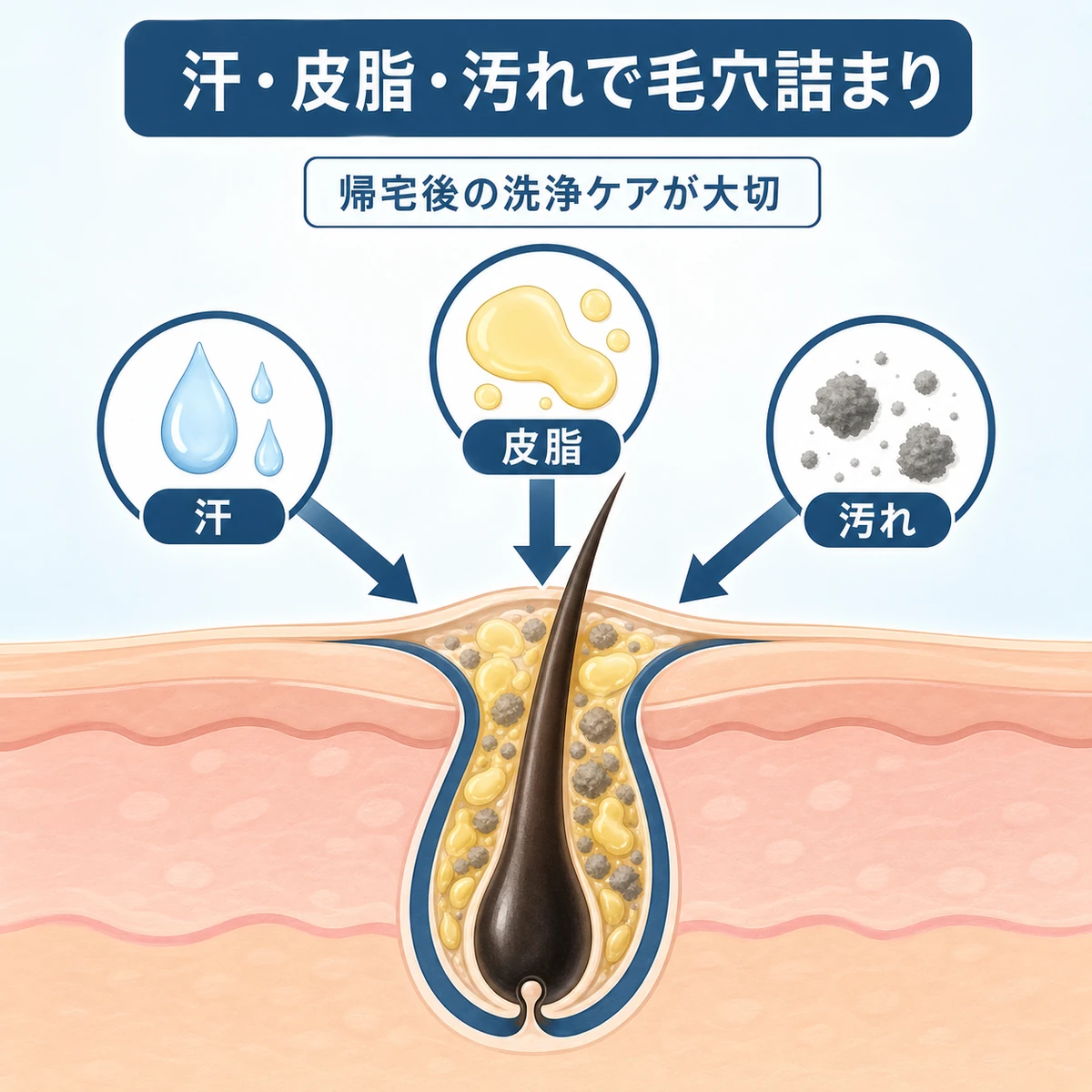 汗と皮脂と汚れが毛穴に詰まり頭皮環境が悪化するしくみを表した医療イラスト