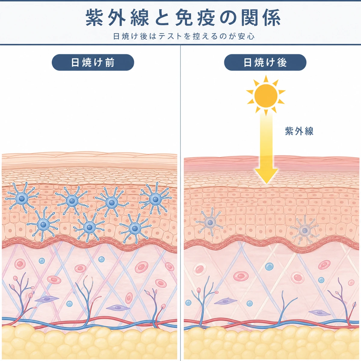 日焼け前後で皮膚の免疫細胞が減る様子を左右で対比した医療イラスト