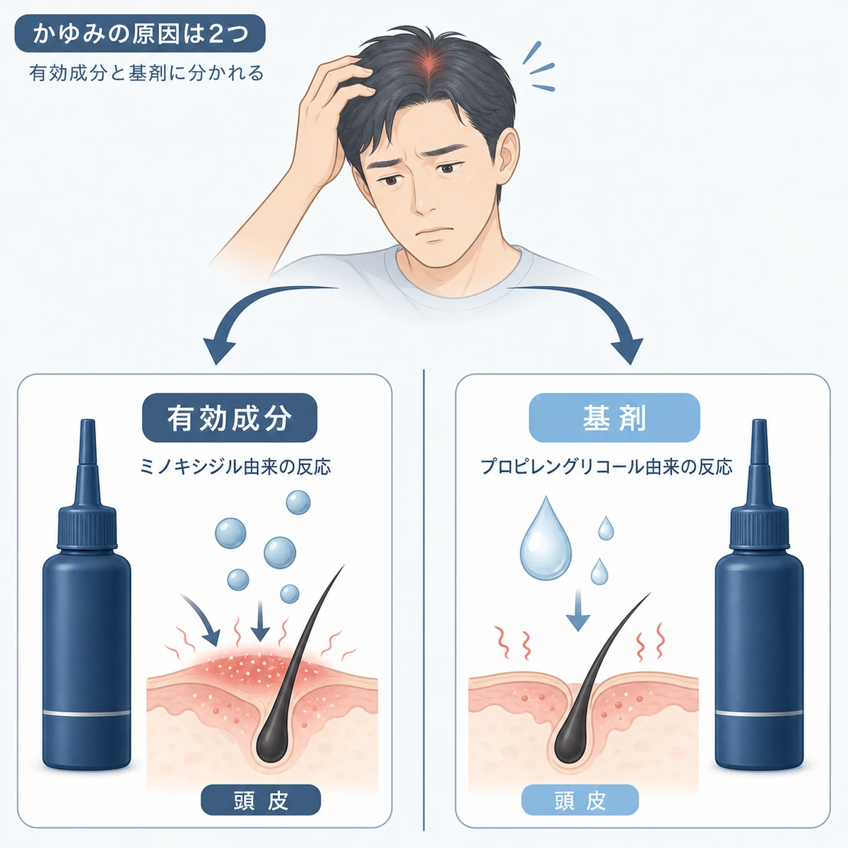 頭皮のかゆみの原因が有効成分と基剤の2つに分かれることを表した医療イラスト