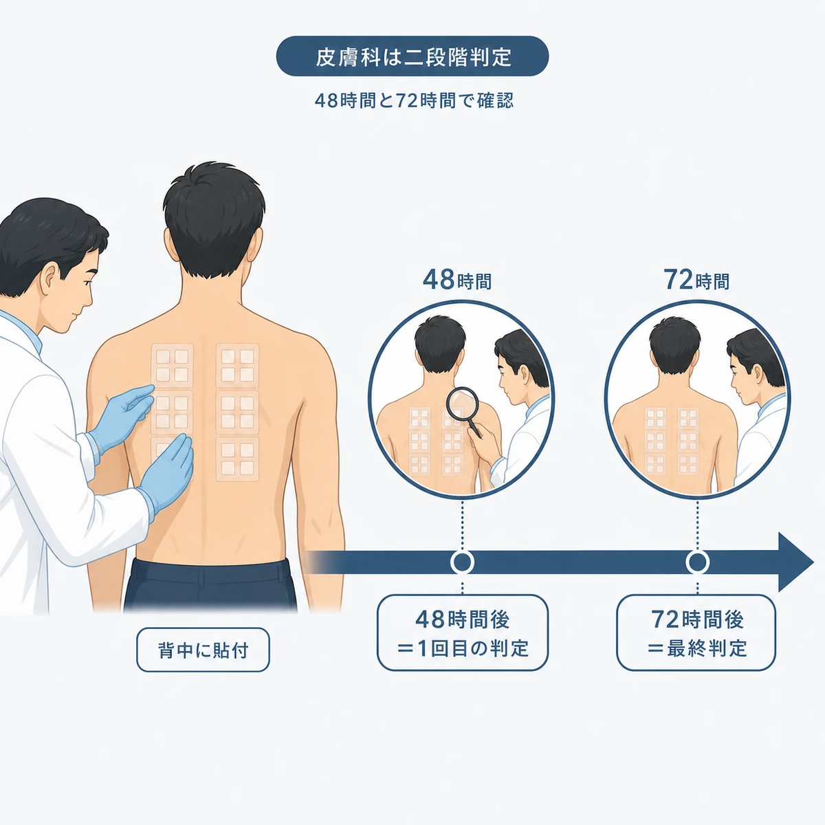 背中にアレルゲンを貼付し48時間と72時間の二段階で判定する皮膚科検査を表した医療イラスト