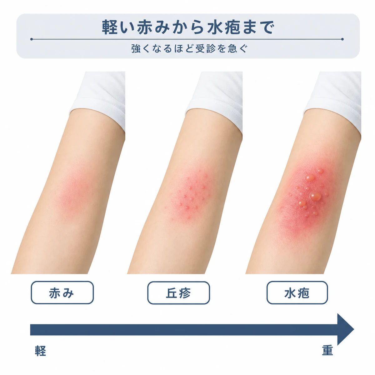 赤みだけから丘疹・水疱へと重症度が高まるパッチテスト陽性反応の段階を表した医療イラスト