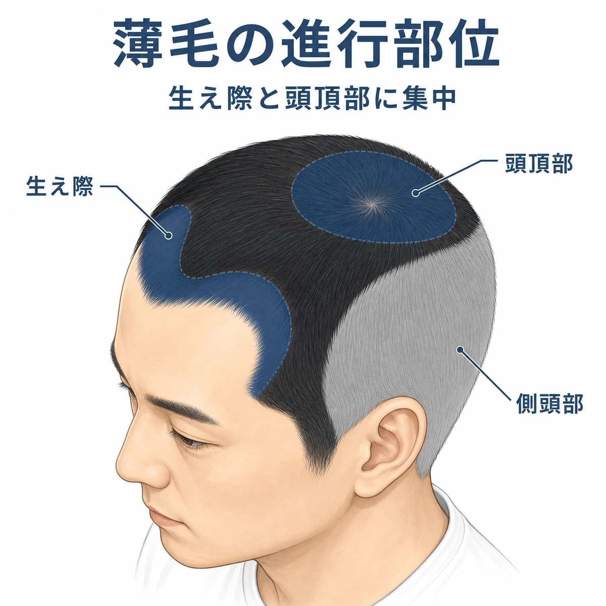 AGAが進行しやすい生え際と頭頂部を色分けした男性の頭部イラスト
