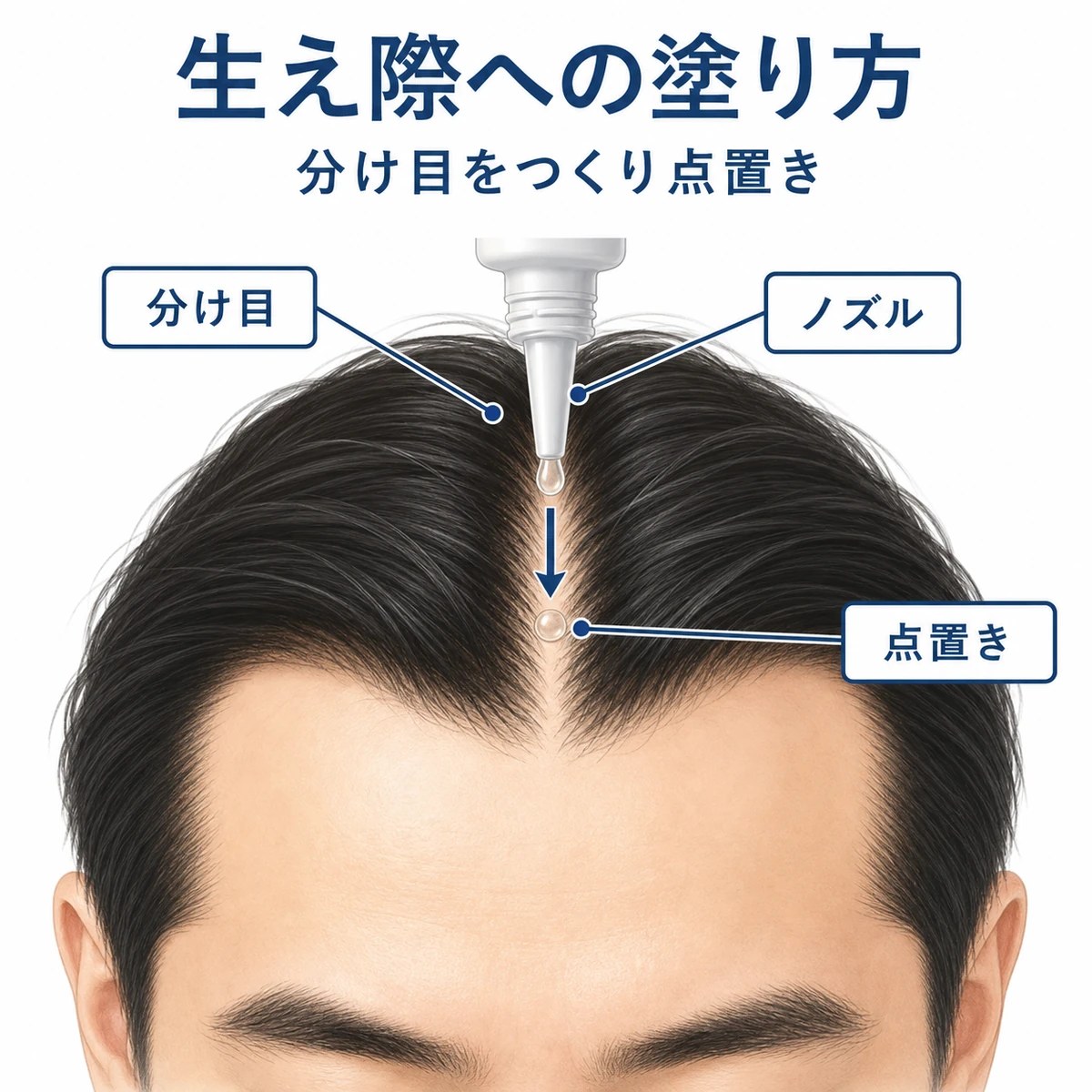 分け目をつくった生え際にノズルで育毛剤を点置きする男性の塗布イラスト