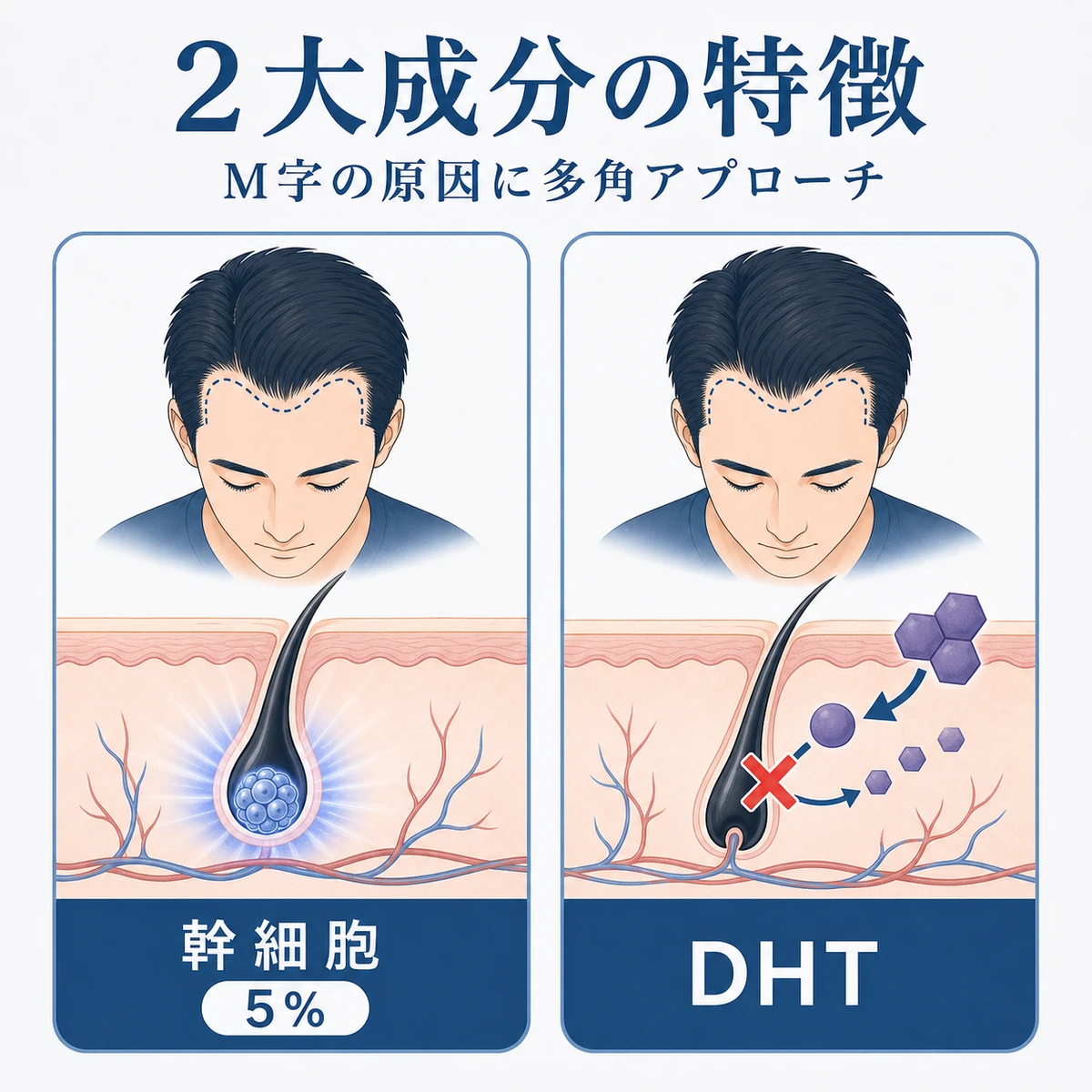 毛包幹細胞への働きかけとDHT抑制という2つの成分の特徴を左右で対比した医療イラスト