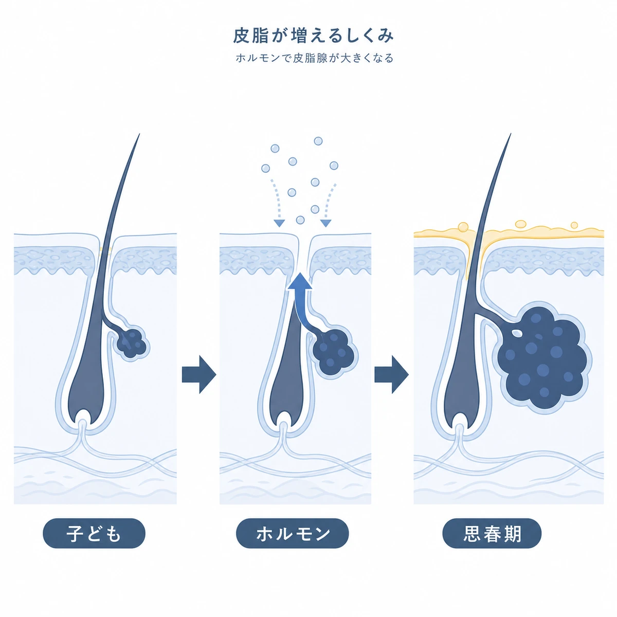 思春期にホルモンで皮脂腺が肥大化し皮脂が増えるしくみを表した頭皮断面の医療イラスト