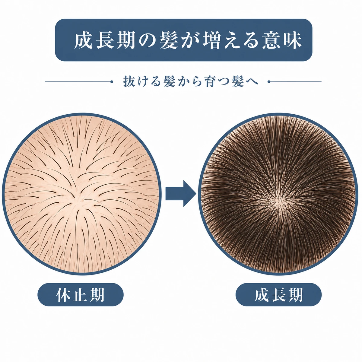 休止期の髪から成長期の髪へ移る変化を表した育毛の医療イラスト