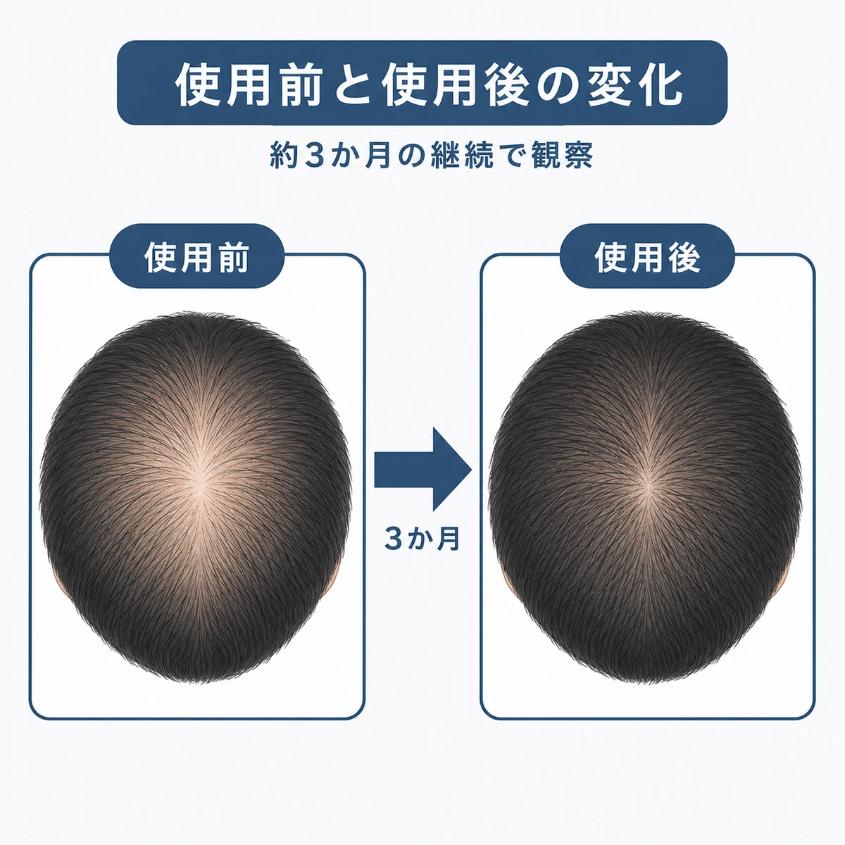 リデンシル使用前と使用後の毛量の変化を左右で比べた育毛イラスト