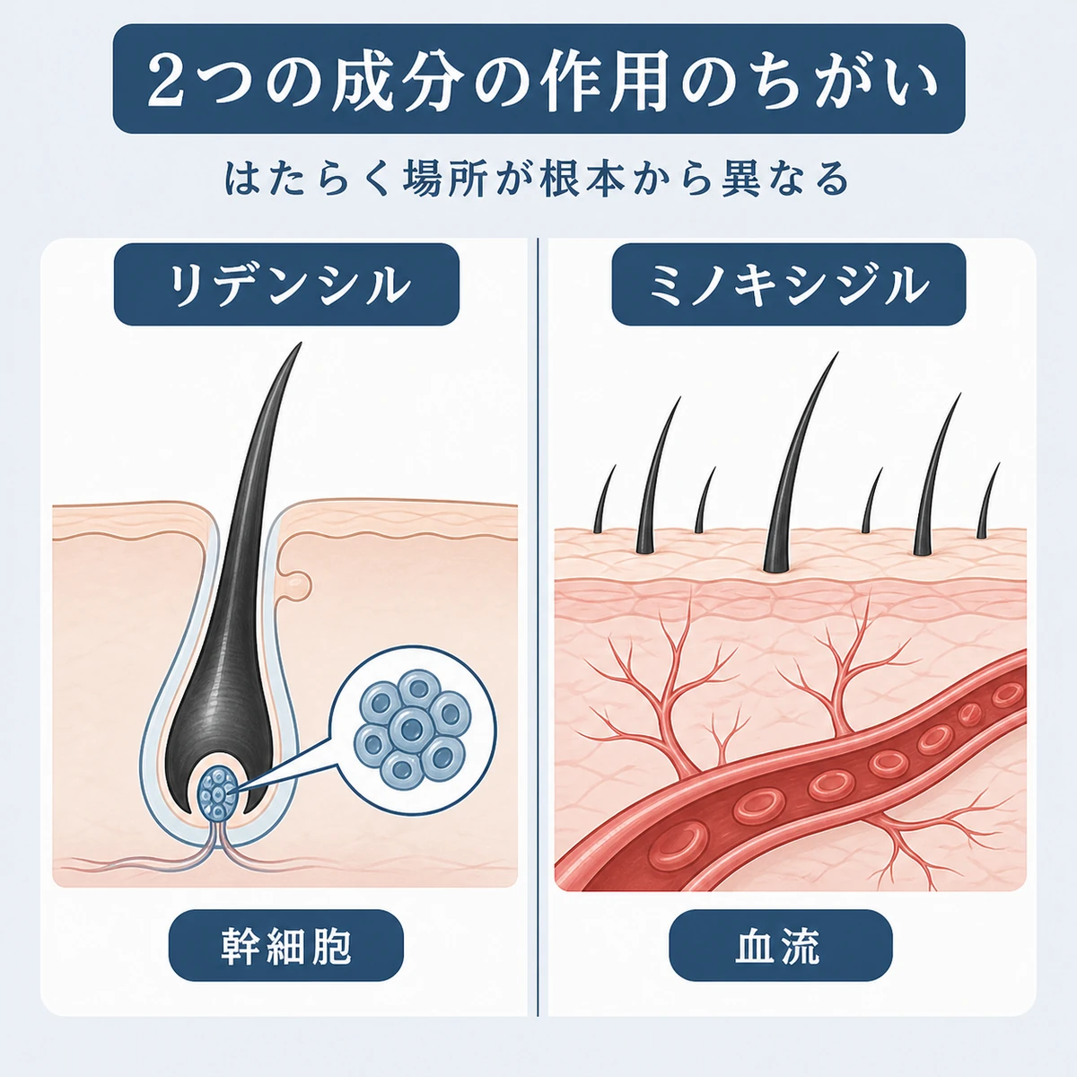 リデンシルとミノキシジルの作用する場所の違いを左右2枚で対比した育毛成分の比較イラスト