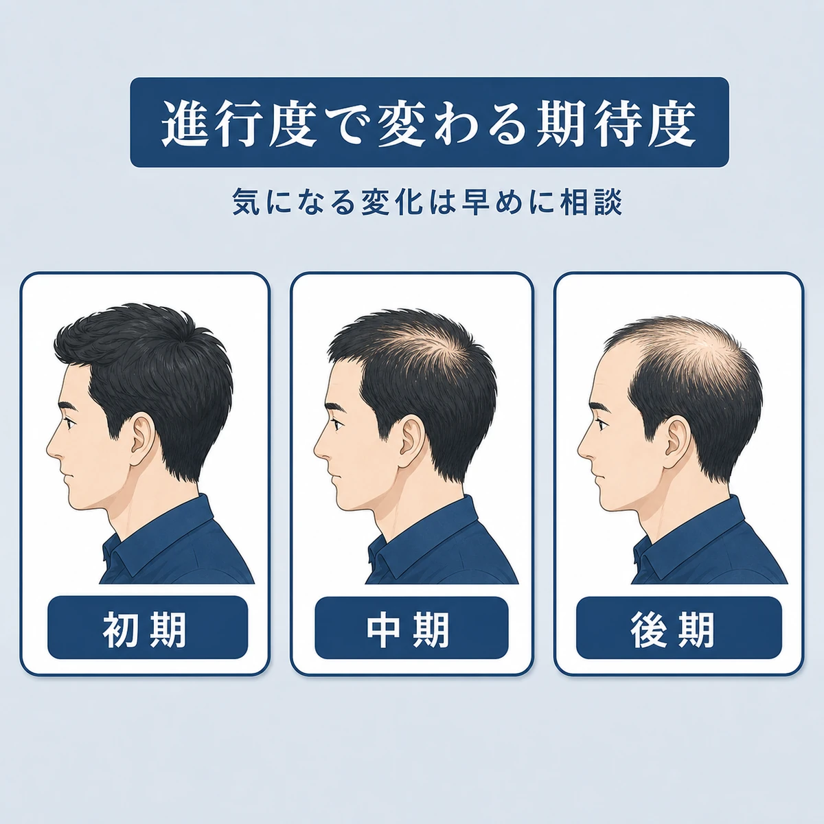 AGAの進行度を初期・中期・後期に分類し成人男性の頭部で毛量の違いを表した育毛イラスト