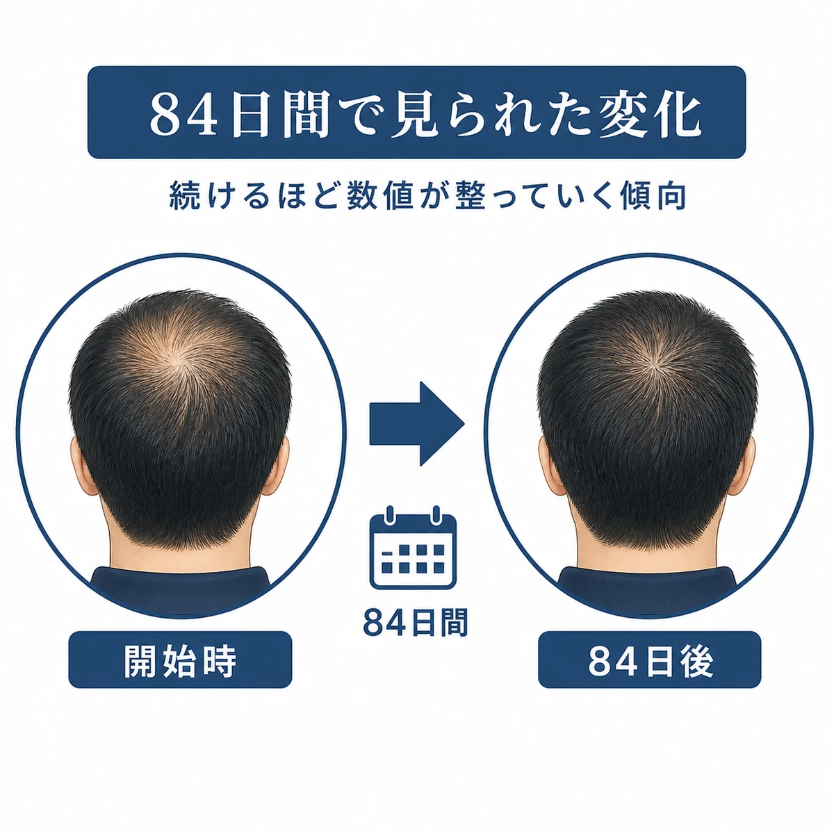 リデンシルを84日間使用した頭頂部の変化を穏やかに対比した医療イラスト