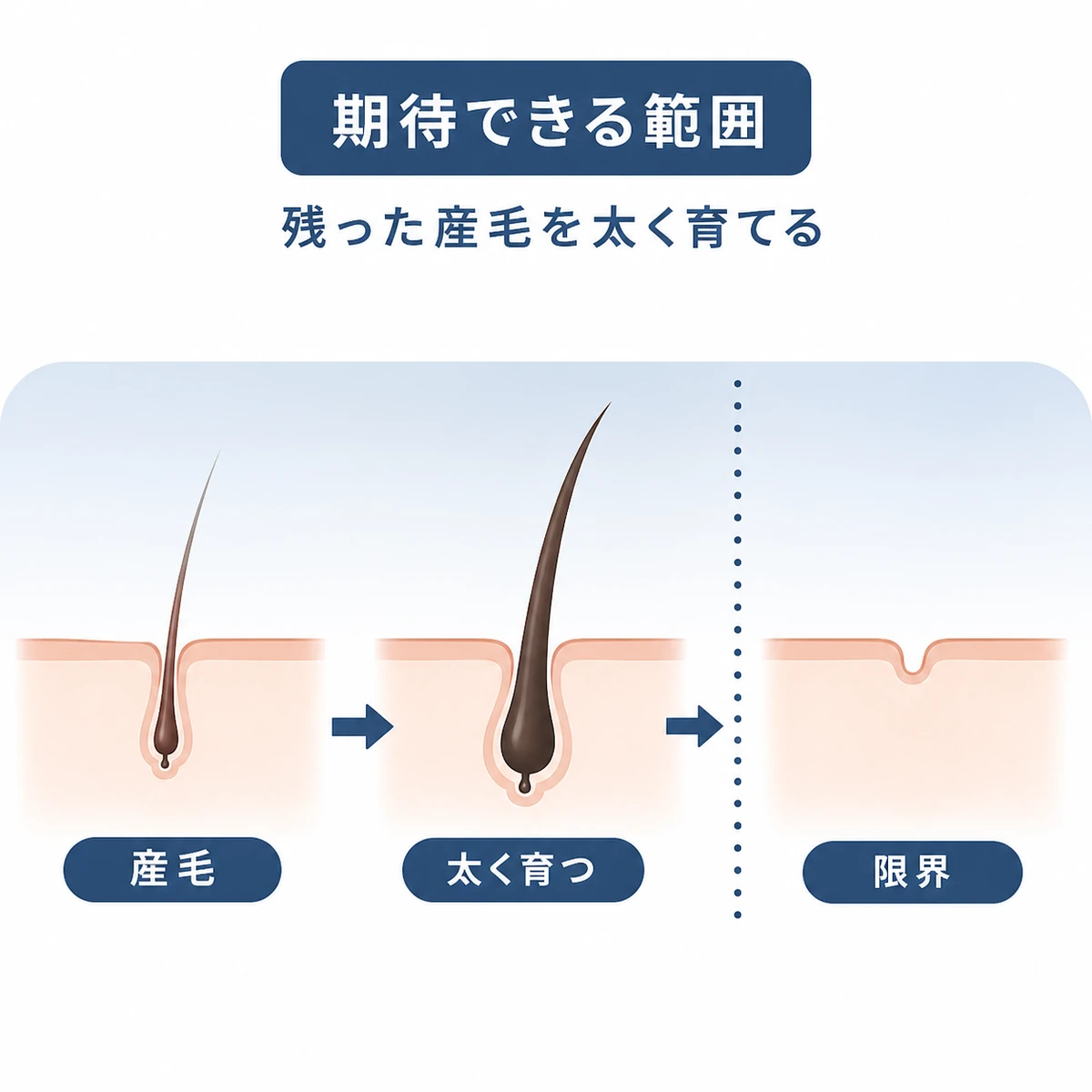 産毛が太く育つ段階と毛根が残らない限界の範囲を横並びで示した医療イラスト