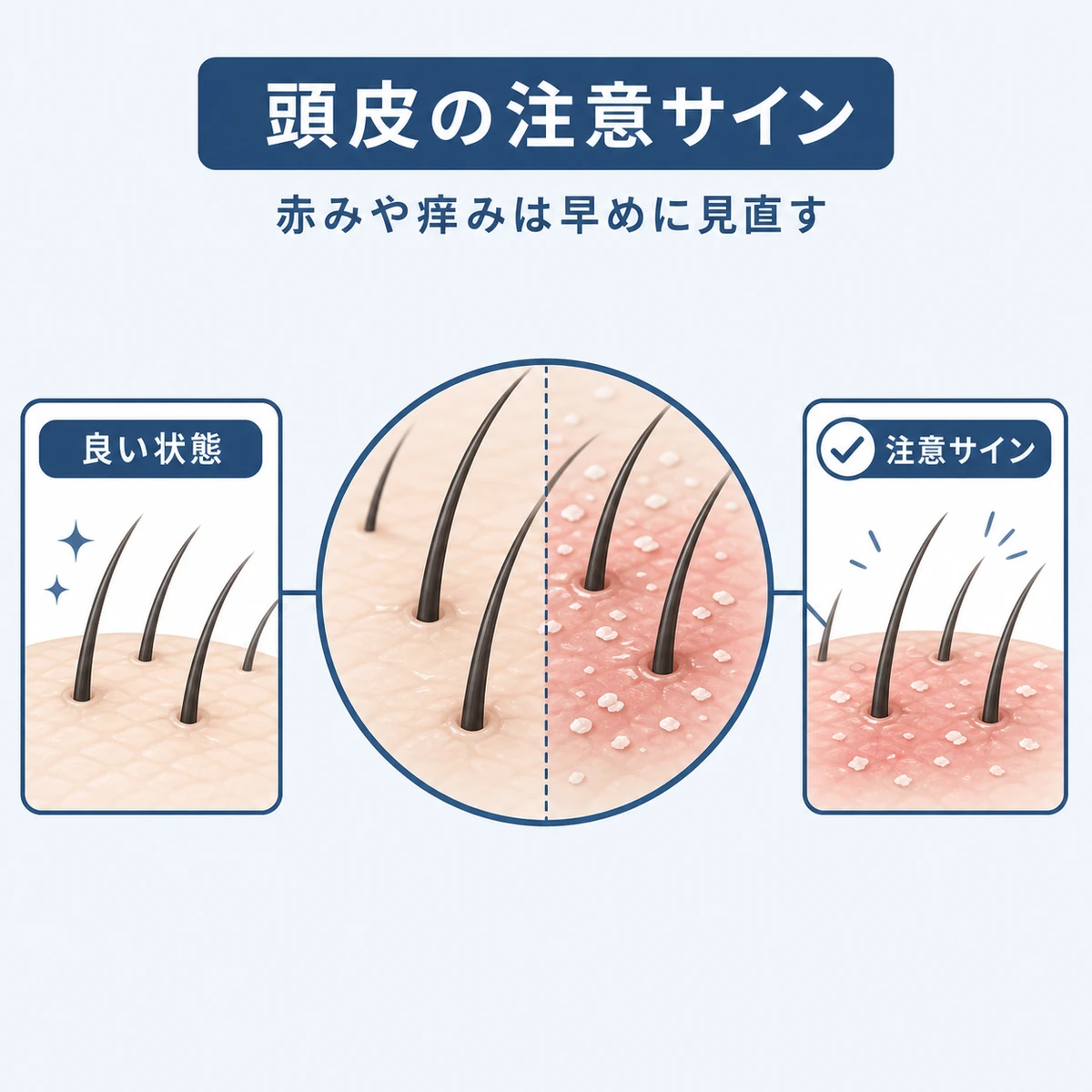 頭皮の良い状態と赤みや痒みなどの注意サインを対比した医療イラスト