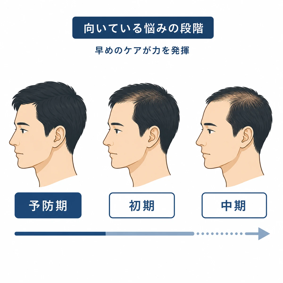リデンシルが向いている薄毛の段階を男性の頭部で表した医療イラスト