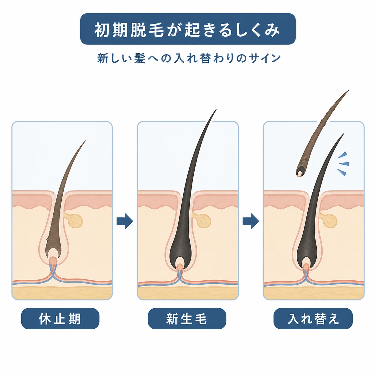休止期の毛が新しい毛に入れ替わる初期脱毛の流れを段階的に表した医療イラスト