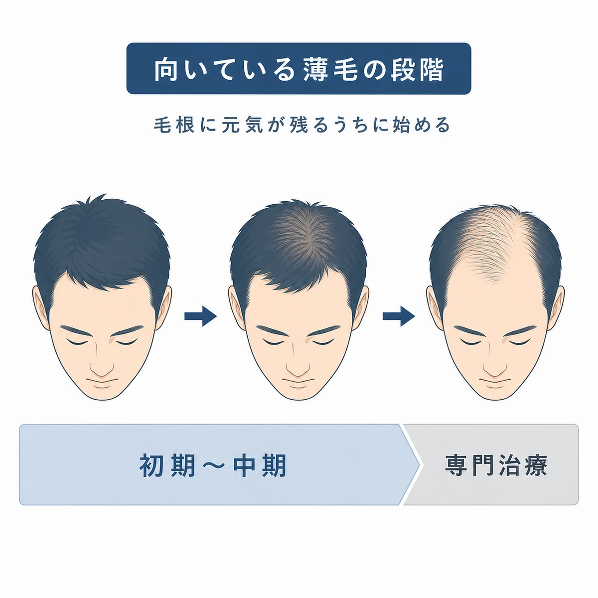 薄毛の進行度ごとにリデンシルが向く段階を表した医療イラスト